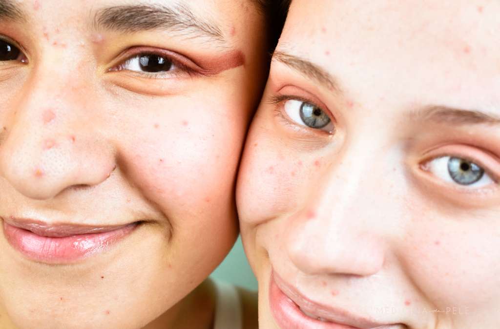 Jovens com acne no rosto sorriem lado a lado, com rostos colados e expressões felizes.