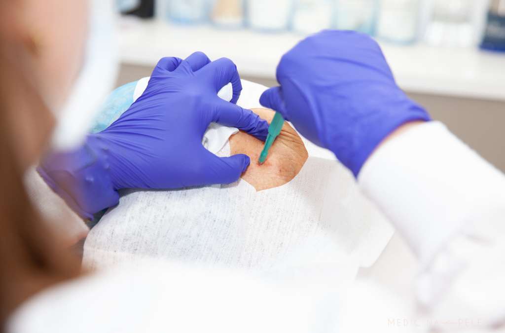 Profissional de luvas azuis realiza procedimento dermatológico no rosto de uma pessoa, utilizando bisturi sobre uma lesão protegida por campo cirúrgico.