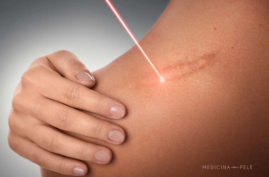 Laser vermelho é aplicado sobre cicatriz no ombro, enquanto a pessoa segura o braço com a outra mão.