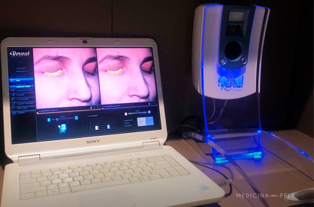 Computador exibe imagens faciais em análise dermatológica, conectado a equipamento Reveal com luz azul.