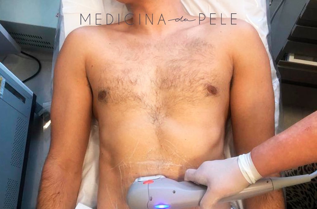 Homem deitado em maca recebe aplicação de aparelho estético com luz azul na região abdominal para tratar flacidez corporal.