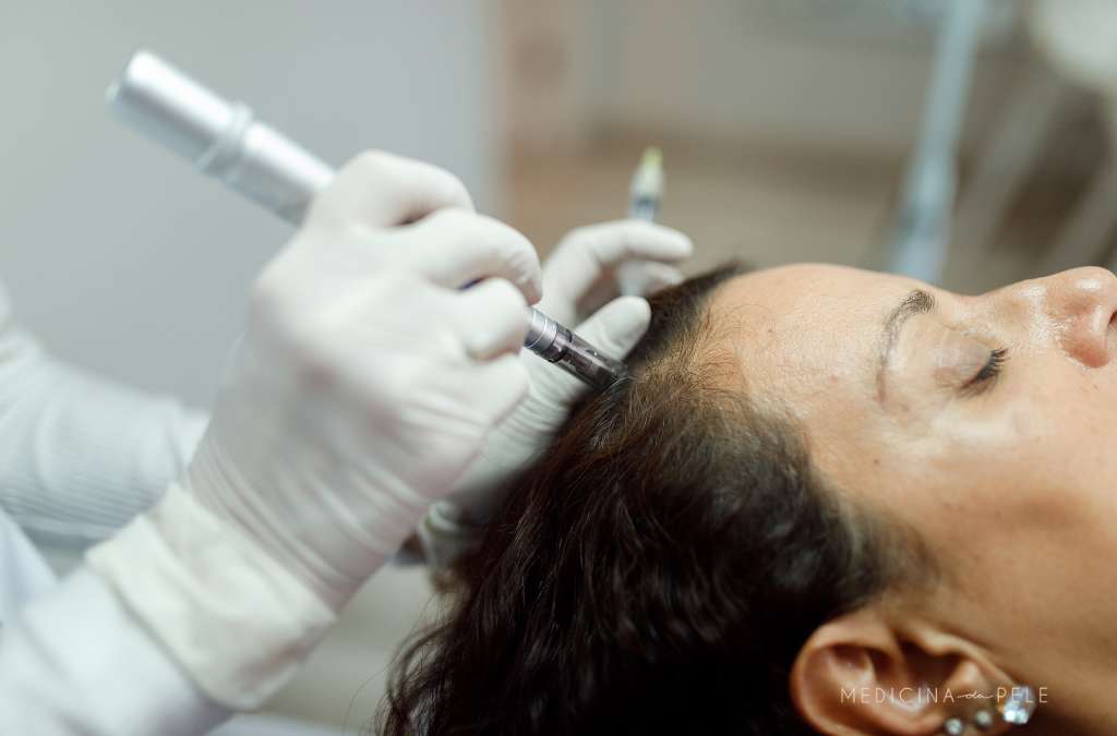 Mulher de olhos fechados recebe aplicação no couro cabeludo com aparelho de microagulhamento.