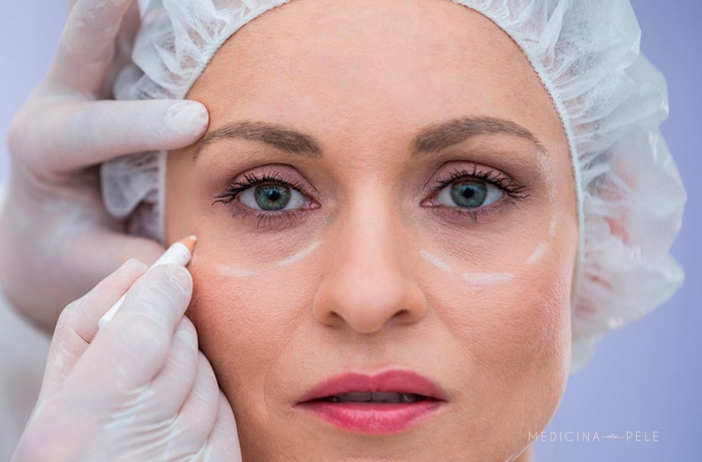 Mulher com touca cirúrgica recebe marcações brancas ao redor dos olhos, preparatórias para procedimento estético.