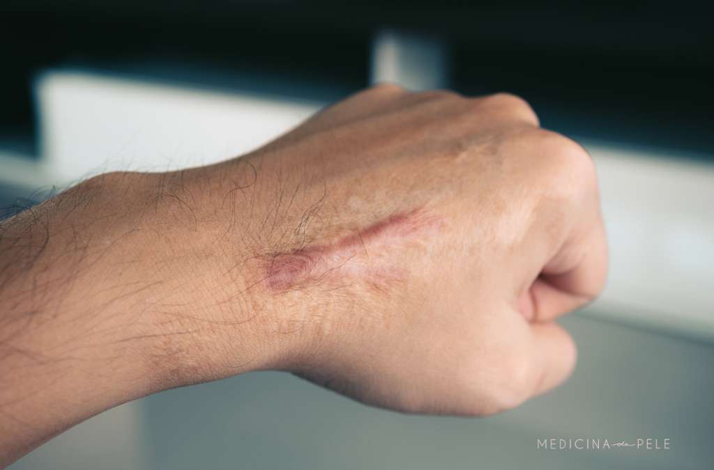 Mão fechada com cicatriz alongada e elevada no dorso, em tom avermelhado, indicando possível queloide.
