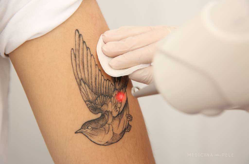 Braço com tatuagem de andorinha sendo submetido a remoção a laser, com ponto de luz vermelha.