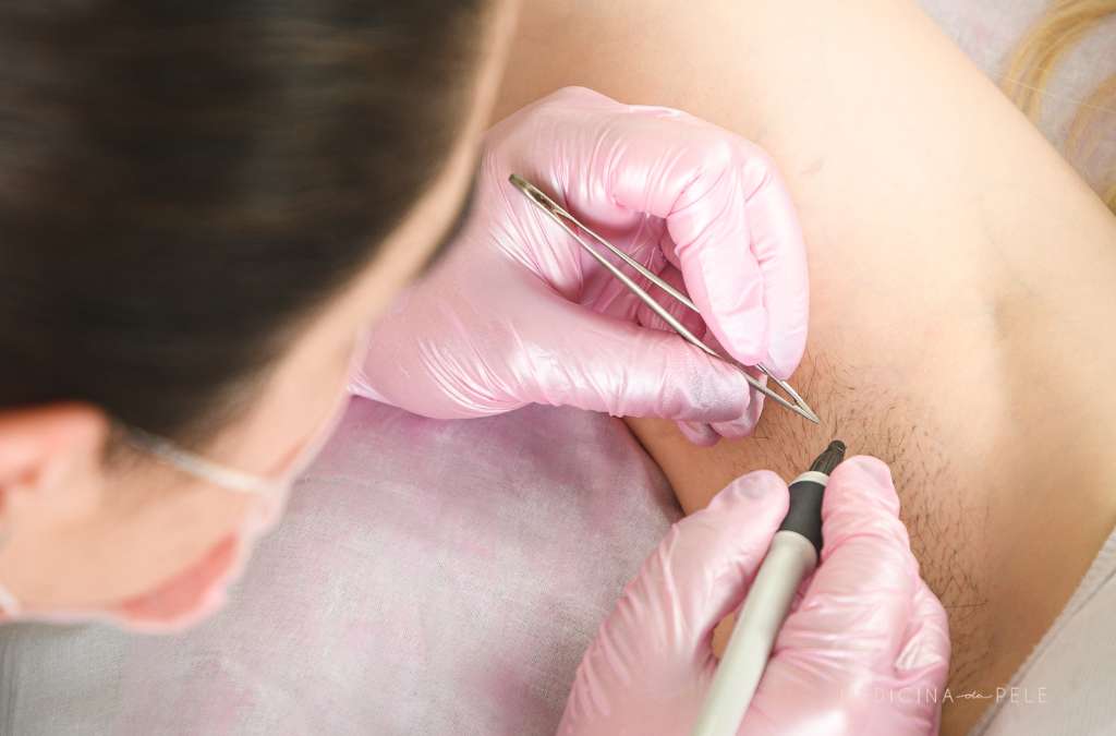 Profissional com luvas rosas realiza depilação a agulha na axila de paciente usando pinça e aparelho.