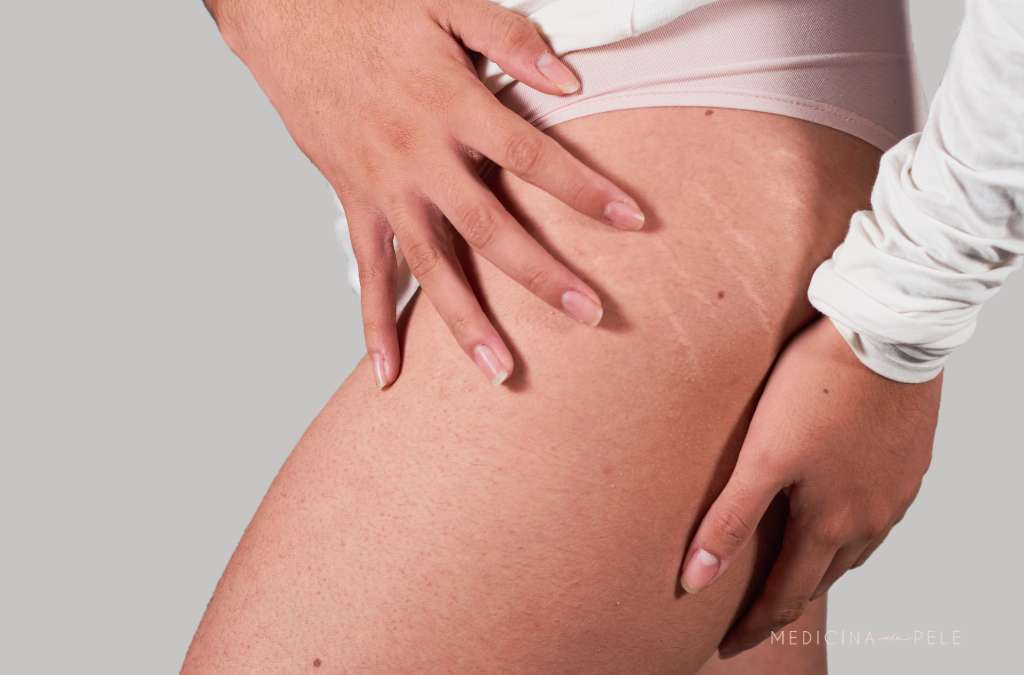 Pessoa em roupa íntima toca a coxa com estrias esbranquiçadas visíveis na lateral da pele.