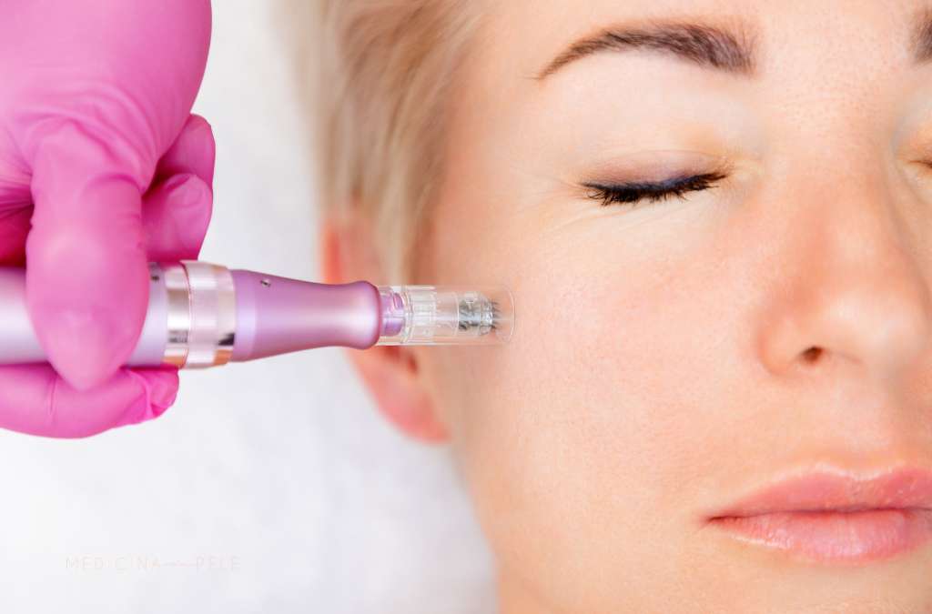 Mulher de olhos fechados recebe aplicação de microagulhamento na bochecha com dermapen manuseada por profissional.