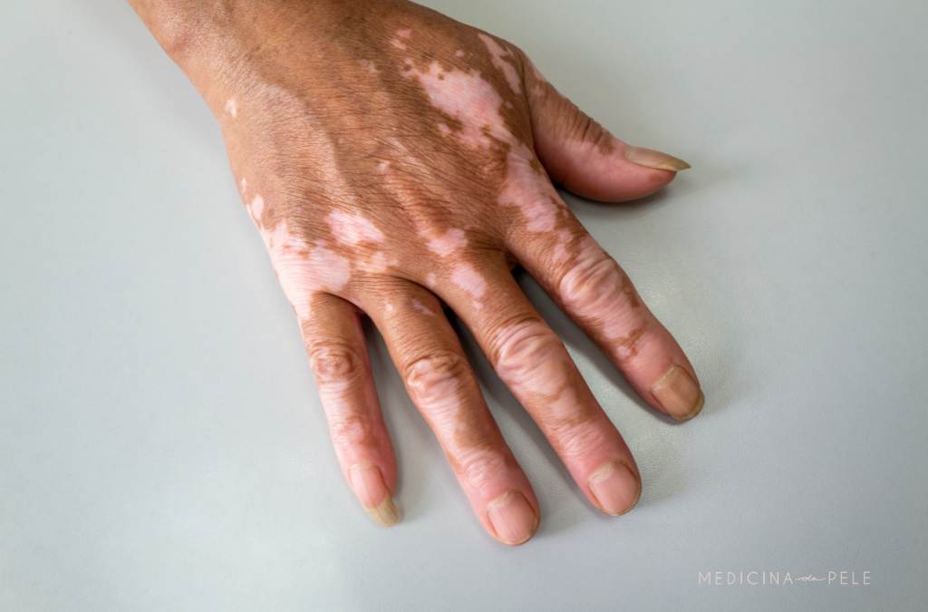 Mão com manchas de vitiligo em fundo cinza claro, com unhas naturais e pele levemente enrugada.