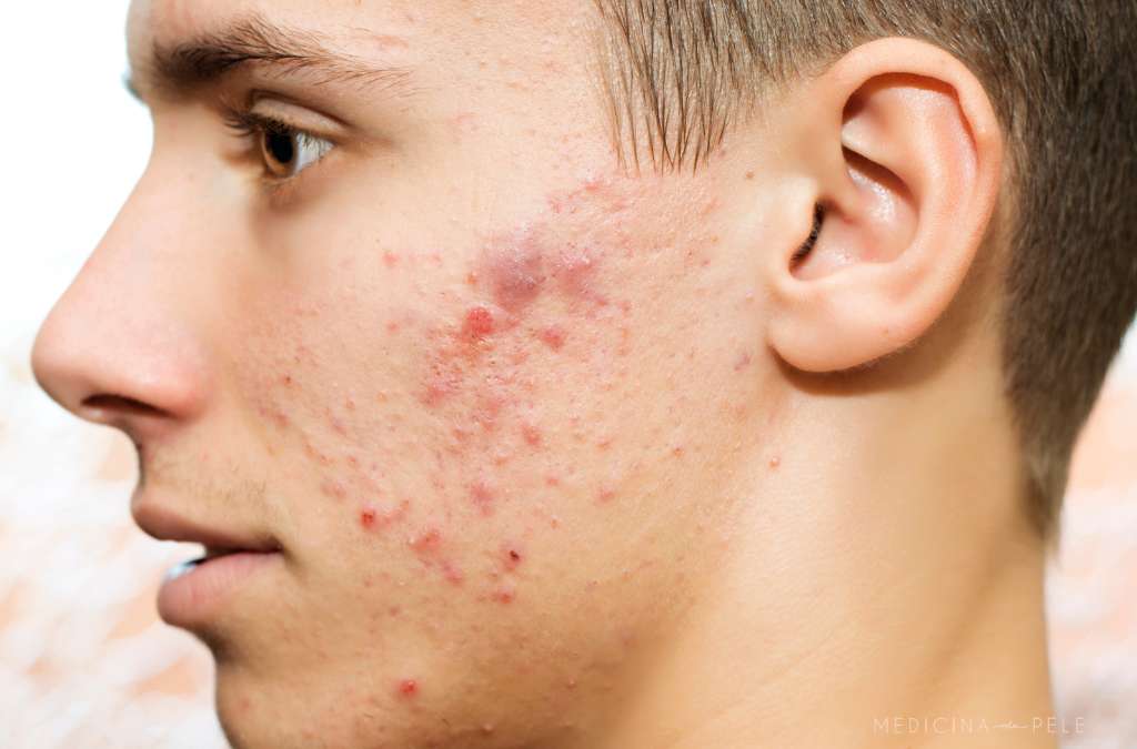 Rosto de rapaz em perfil esquerdo, bochecha marcada por espinhas vermelhas e lesões inflamadas.