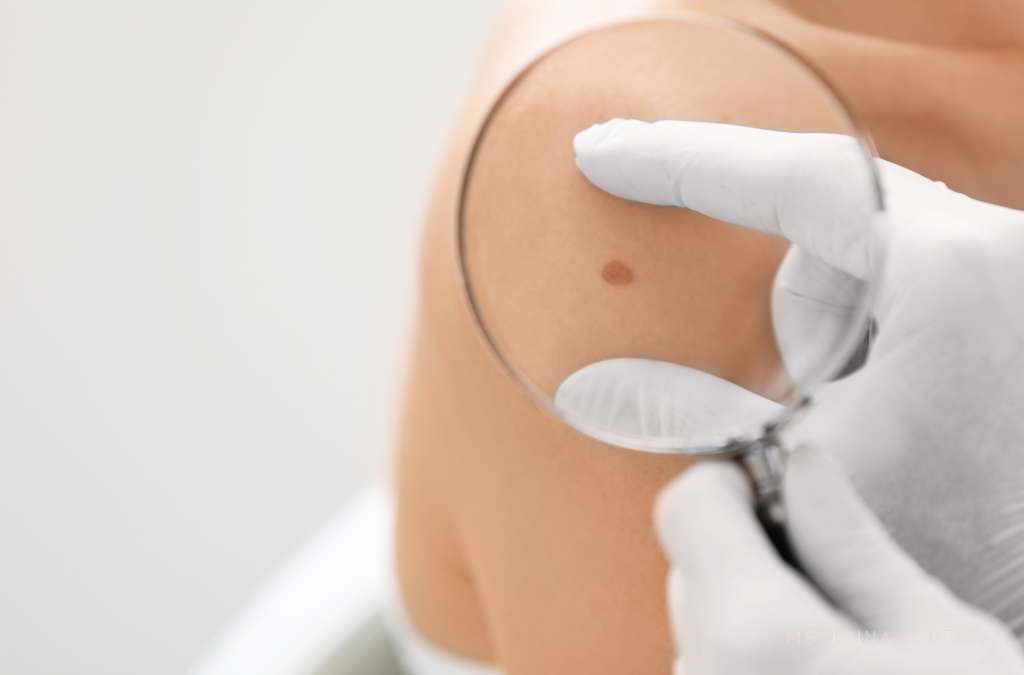 Fotografia mostra um profissional com luvas brancas examinando uma pinta escura no ombro de uma pessoa com uma lupa, sugerindo avaliação dermatológica para detecção de câncer de pele.