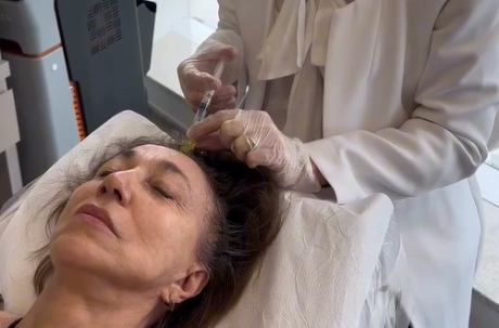 Profissional com luvas azuis aplica injeção no couro cabeludo de paciente, em procedimento estético.