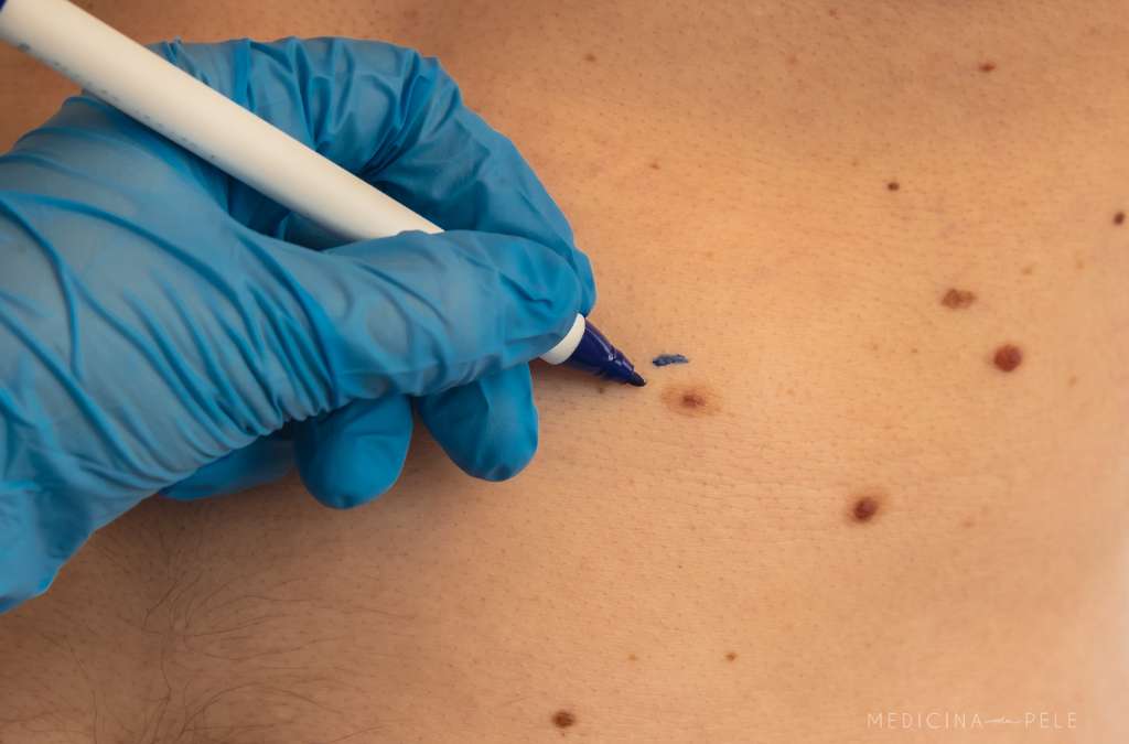 Profissional com luva azul marca nevo castanho no tórax de paciente usando caneta cirúrgica azul.