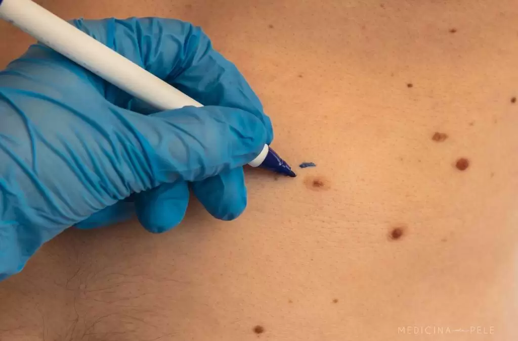 Profissional com luva azul marca nevo castanho no tórax de paciente usando caneta cirúrgica azul.