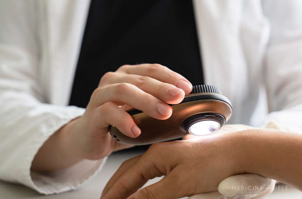 Fotografia mostra um profissional de branco realizando exame de dermatoscopia com aparelho luminoso sobre a mão de um paciente, observando detalhadamente a pele.
