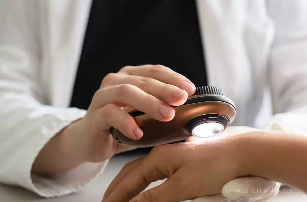 Fotografia mostra um profissional de branco realizando exame de dermatoscopia com aparelho luminoso sobre a mão de um paciente, observando detalhadamente a pele.