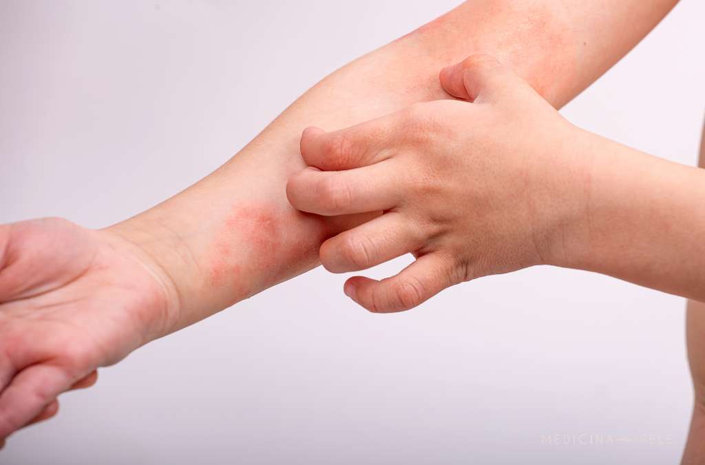 Fotografia mostra uma criança coçando o antebraço esquerdo, que apresenta áreas avermelhadas e irritadas na pele, características de eczema ou dermatite.