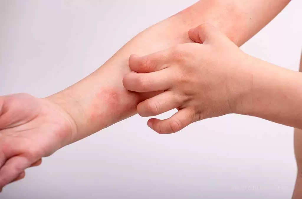 Fotografia mostra uma criança coçando o antebraço esquerdo, que apresenta áreas avermelhadas e irritadas na pele, características de eczema ou dermatite.