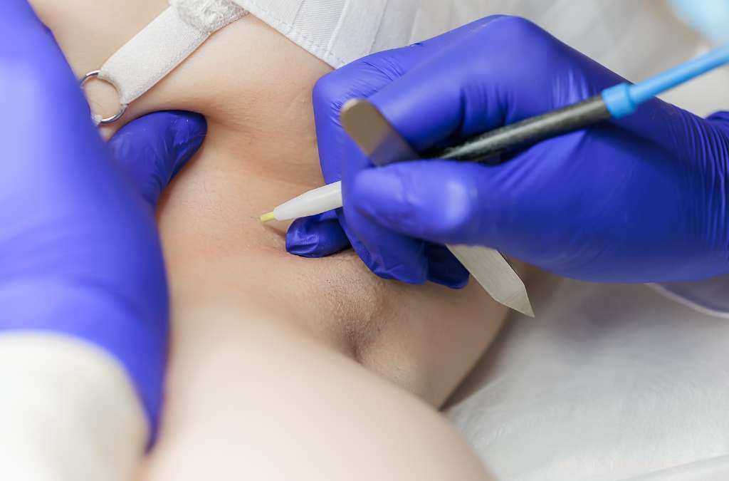 Profissional com luvas azuis remove pelos da axila de paciente deitada usando caneta eletrolítica.