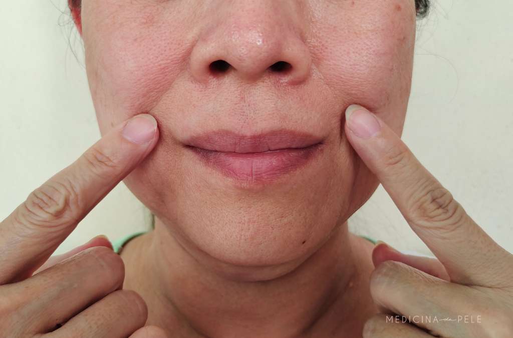 Mulher aponta com os dedos para linhas de expressão nas laterais da boca, com expressão neutra.