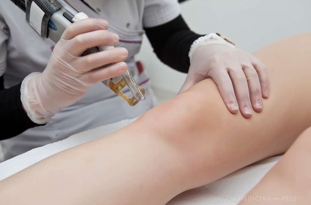 Profissional com luvas aplica laser na perna de paciente deitada, em procedimento dermatológico.