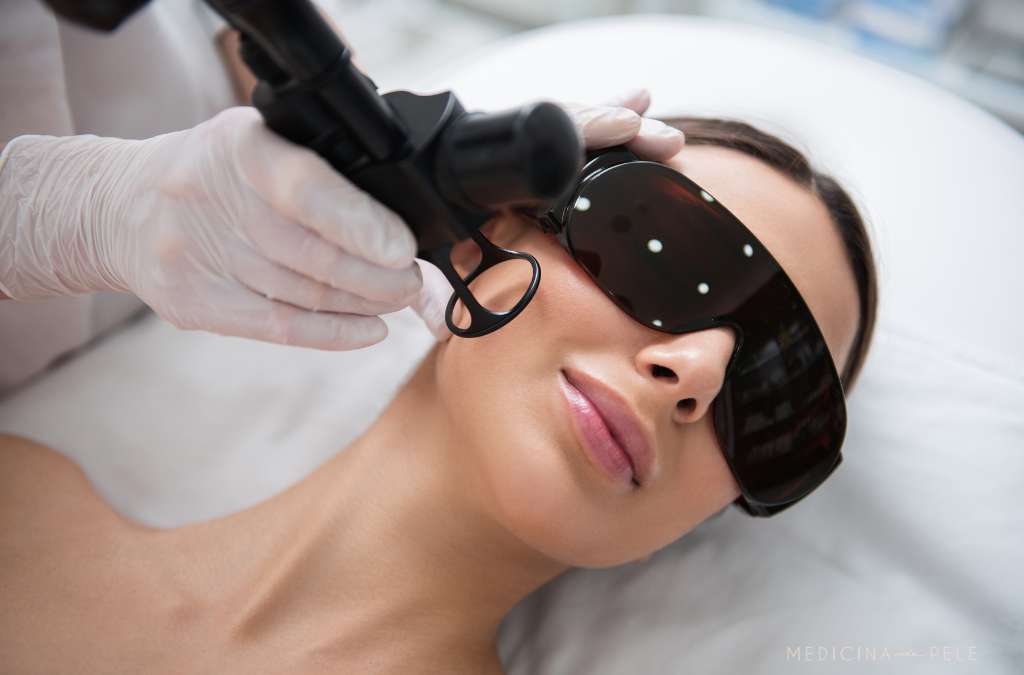 Mulher deitada com óculos protetores grandes recebe disparo de laser facial por profissional de luvas.