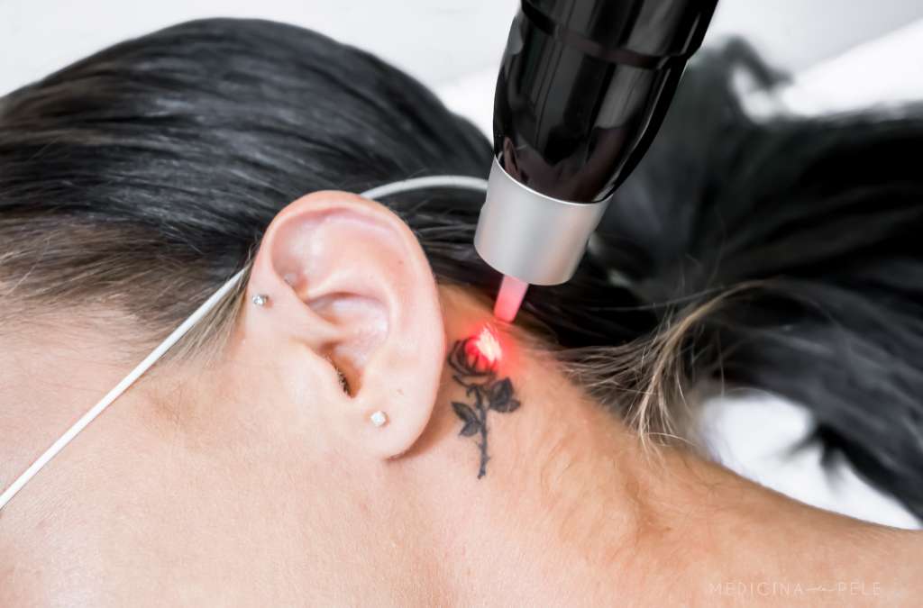 Laser vermelho remove tatuagem de rosa no pescoço, mulher usa óculos de proteção.