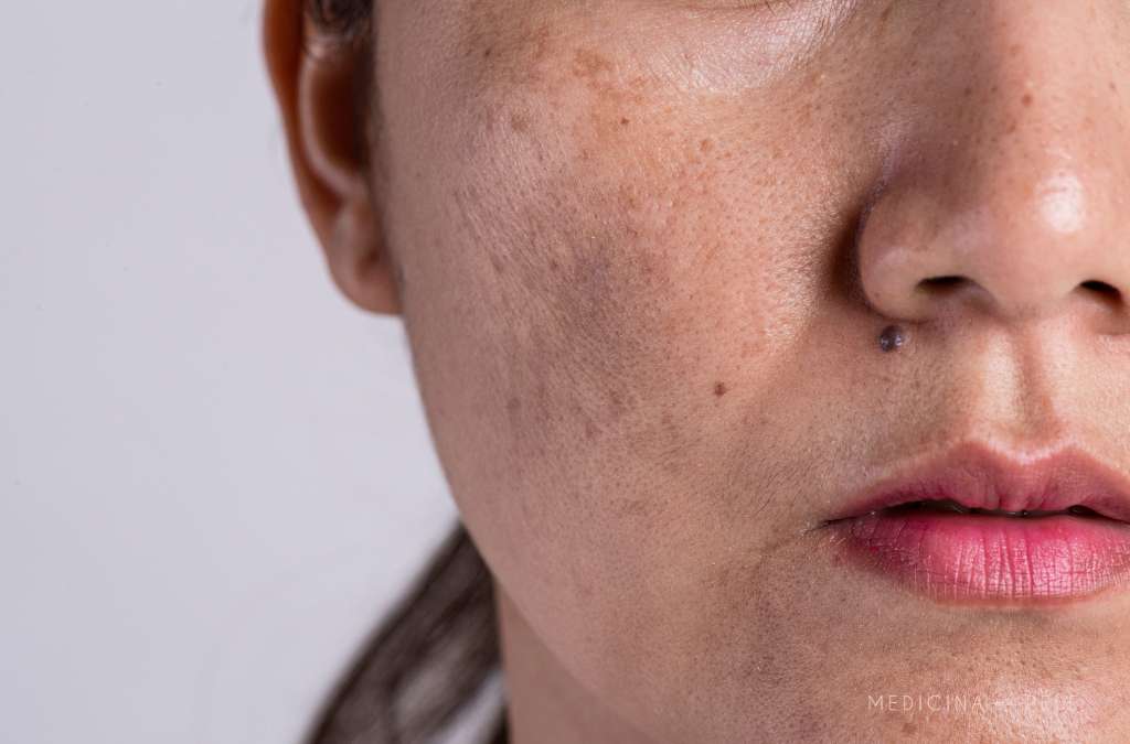 Fotografia mostra o close do rosto de uma mulher com manchas escuras e irregulares nas bochechas, típicas de melasma.