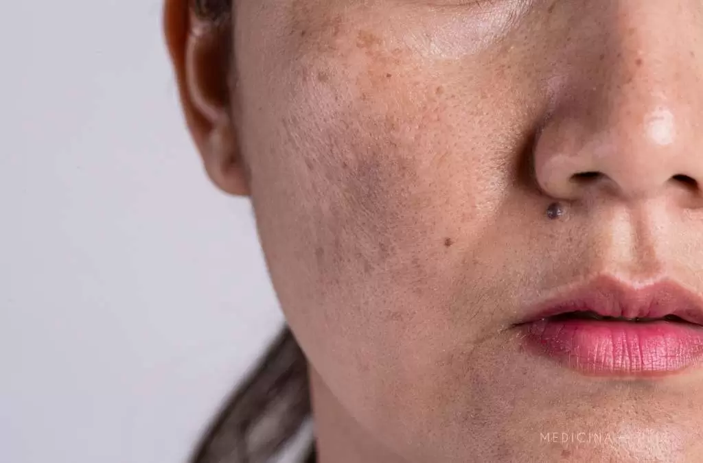 Fotografia mostra o close do rosto de uma mulher com manchas escuras e irregulares nas bochechas, típicas de melasma.