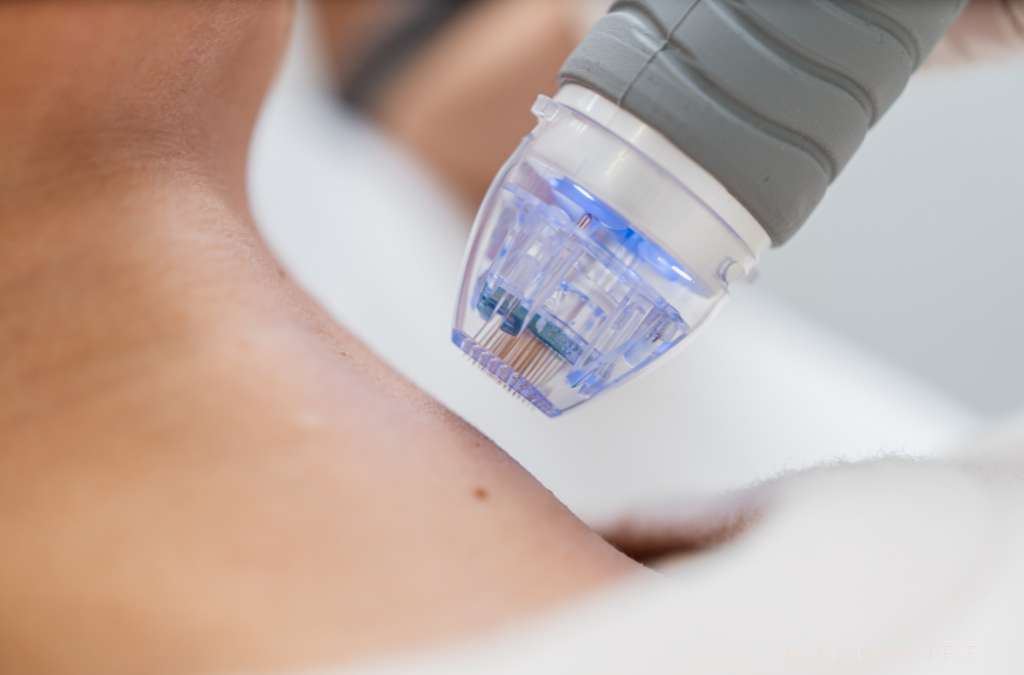 Aparelho de microagulhamento azul encosta no ombro de paciente para rejuvenescimento da pele.