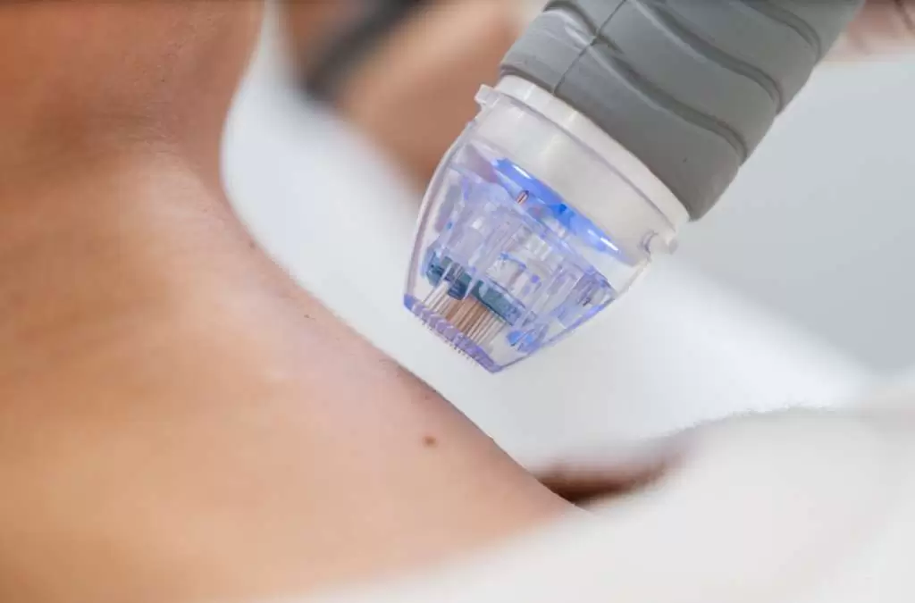 Aparelho de microagulhamento azul encosta no ombro de paciente para rejuvenescimento da pele.
