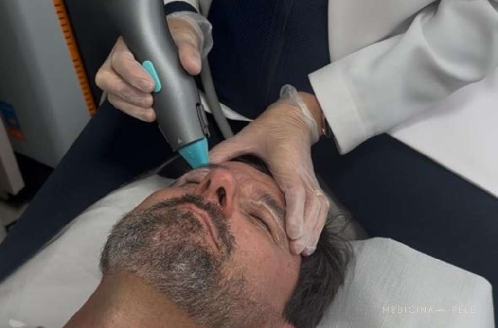Fotografia mostra um homem deitado recebendo aplicação de radiofrequência monopolar na região frontal do rosto por profissional com luvas, procedimento usado para estímulo de colágeno e rejuvenescimento.