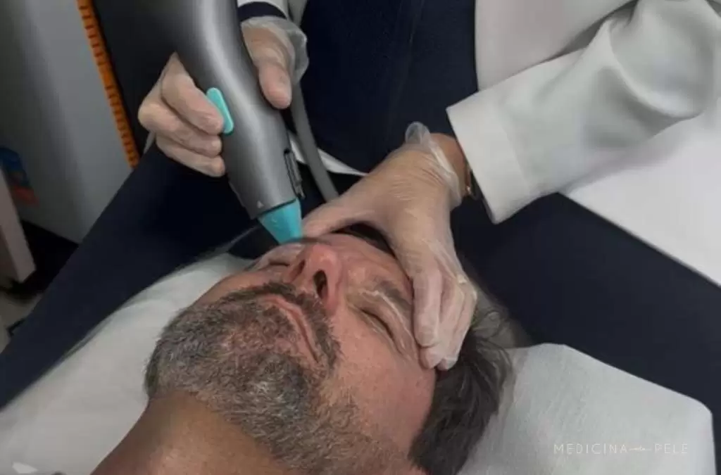 Fotografia mostra um homem deitado recebendo aplicação de radiofrequência monopolar na região frontal do rosto por profissional com luvas, procedimento usado para estímulo de colágeno e rejuvenescimento.