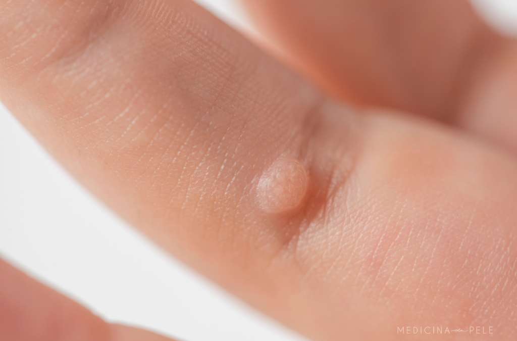 Close-up de verruga clara e elevada na lateral de um dedo, com textura áspera, indicando possível lesão por HPV.