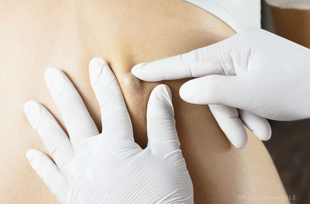 Close-up de mãos com luvas brancas examinando nódulo subcutâneo nas costas de um paciente, sugerindo avaliação dermatológica.
