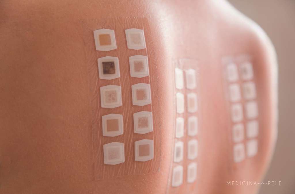 Fotografia mostra as costas de uma pessoa com adesivos retangulares aplicados para teste de contato, utilizado na identificação de alergias dermatológicas.
