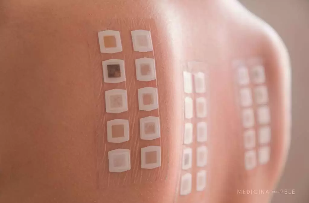 Fotografia mostra as costas de uma pessoa com adesivos retangulares aplicados para teste de contato, utilizado na identificação de alergias dermatológicas.