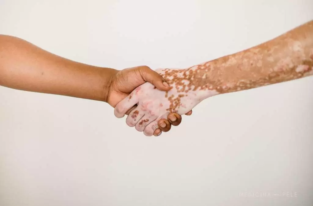 Mãos se cumprimentando: uma de pele escura uniforme, outra clara com manchas de vitiligo