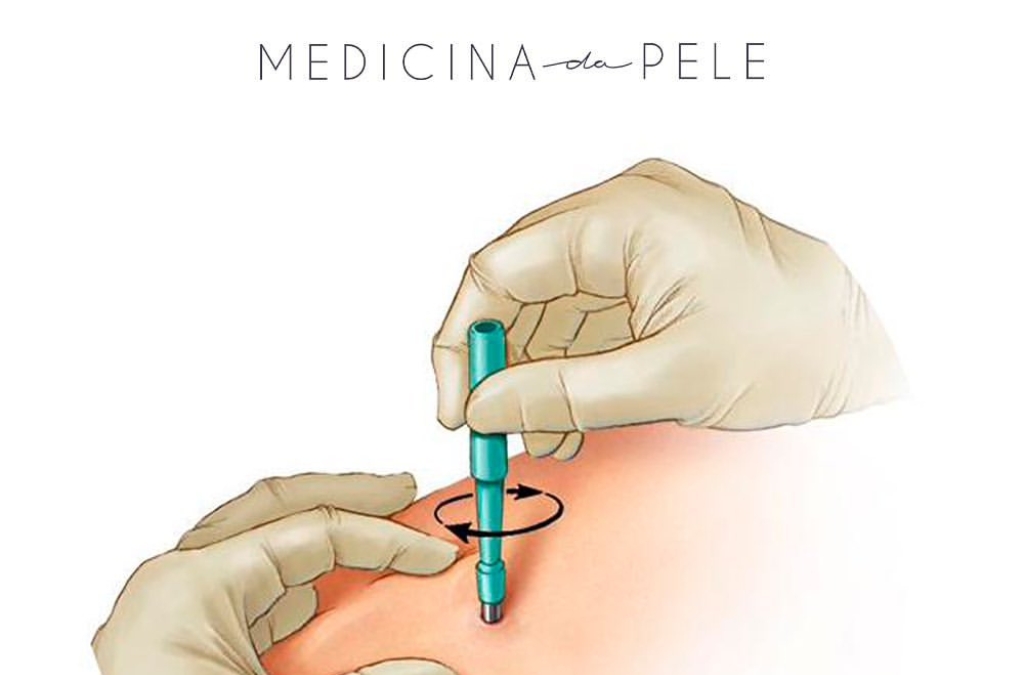 Ilustração mostra mãos com luvas realizando biópsia de pele com punch, girando o instrumento sobre a área.
