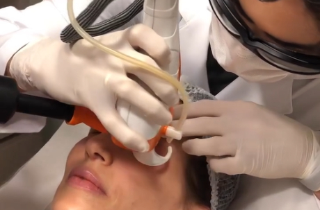 Profissional de saúde aplicando laser de CO₂ na região das pálpebras de uma paciente deitada, usando óculos de proteção, com a legenda “Laser de CO₂ para flacidez das pálpebras”.