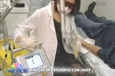 Profissional de jaleco, óculos de proteção e luvas realiza procedimento de remoção de tatuagem a laser no braço de paciente, com legenda informativa na tela.