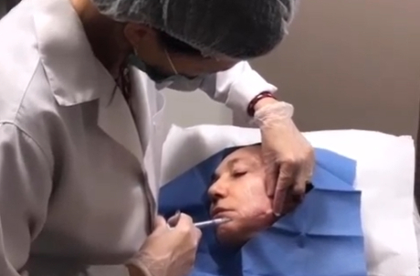 Fotografia de uma profissional de saúde aplicando Radiesse no rosto de uma paciente deitada, com campo estéril azul protegendo a área, acompanhada da legenda “Aplicação de Radiesse para melhora do contorno facial”.