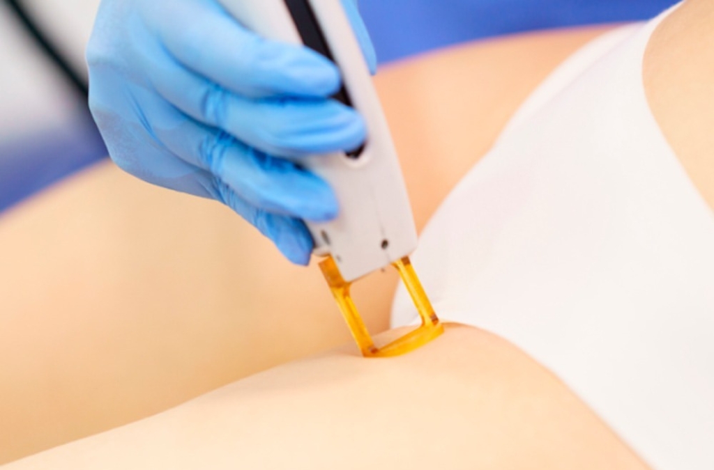 Mão com luva azul realiza aplicação de laser depilatório na região abdominal de pessoa com roupa branca.