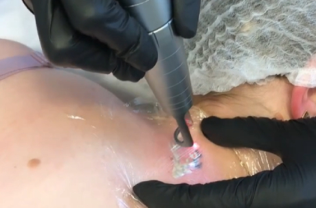 Profissional com luvas pretas utiliza equipamento a laser para tratamento estético na pele do ombro de paciente.
