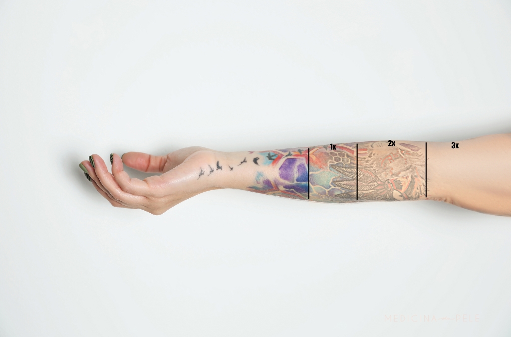 Braço tatuado visto de lado com áreas delimitadas e numeradas mostrando estágios de clareamento da tatuagem.